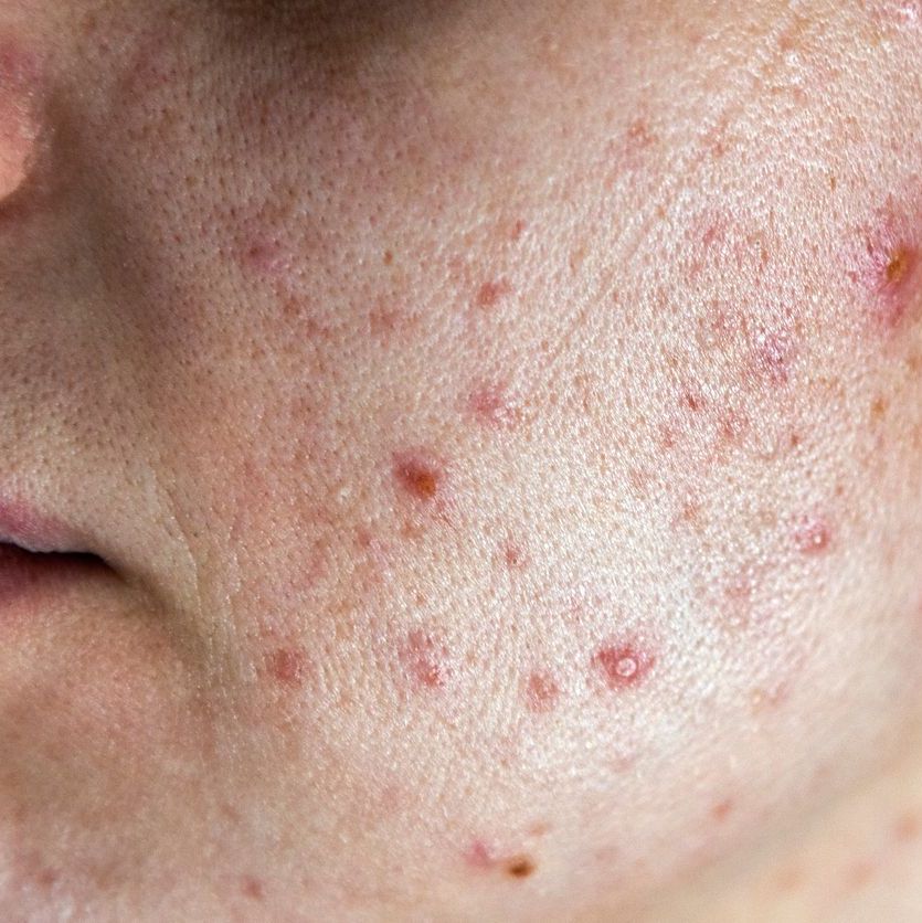 Closeup of woman face with bad skin and red acne.